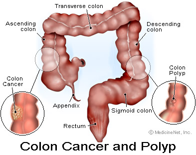 How do you get colon cancer?